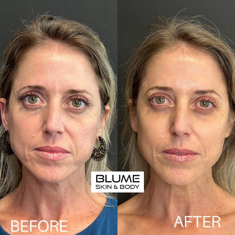 Dermal Fillers Before & After