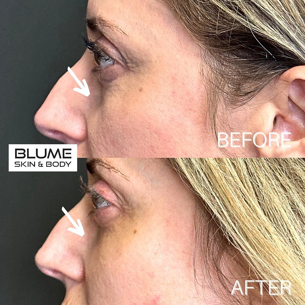 Dermal Fillers Before & After