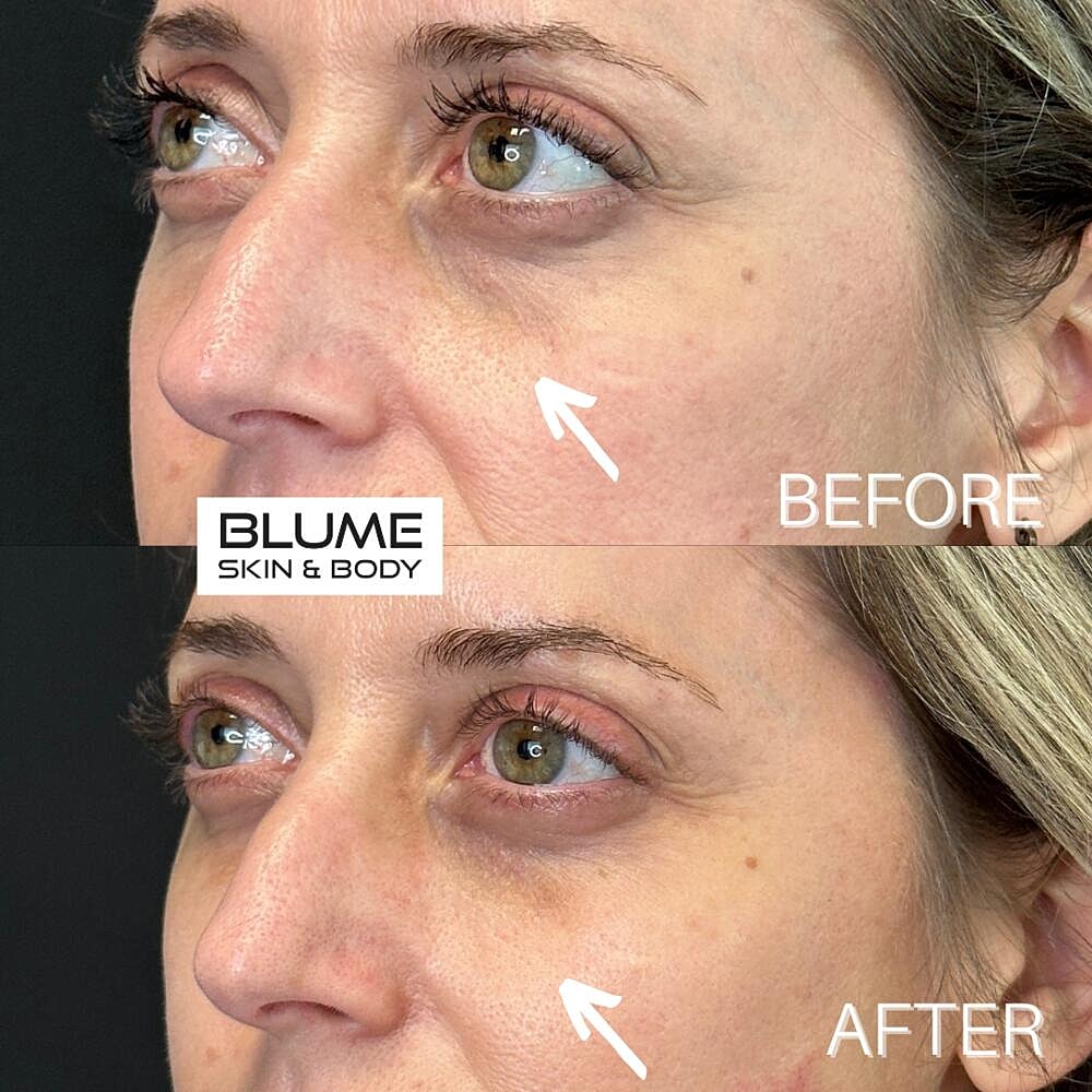 Dermal Fillers Before & After