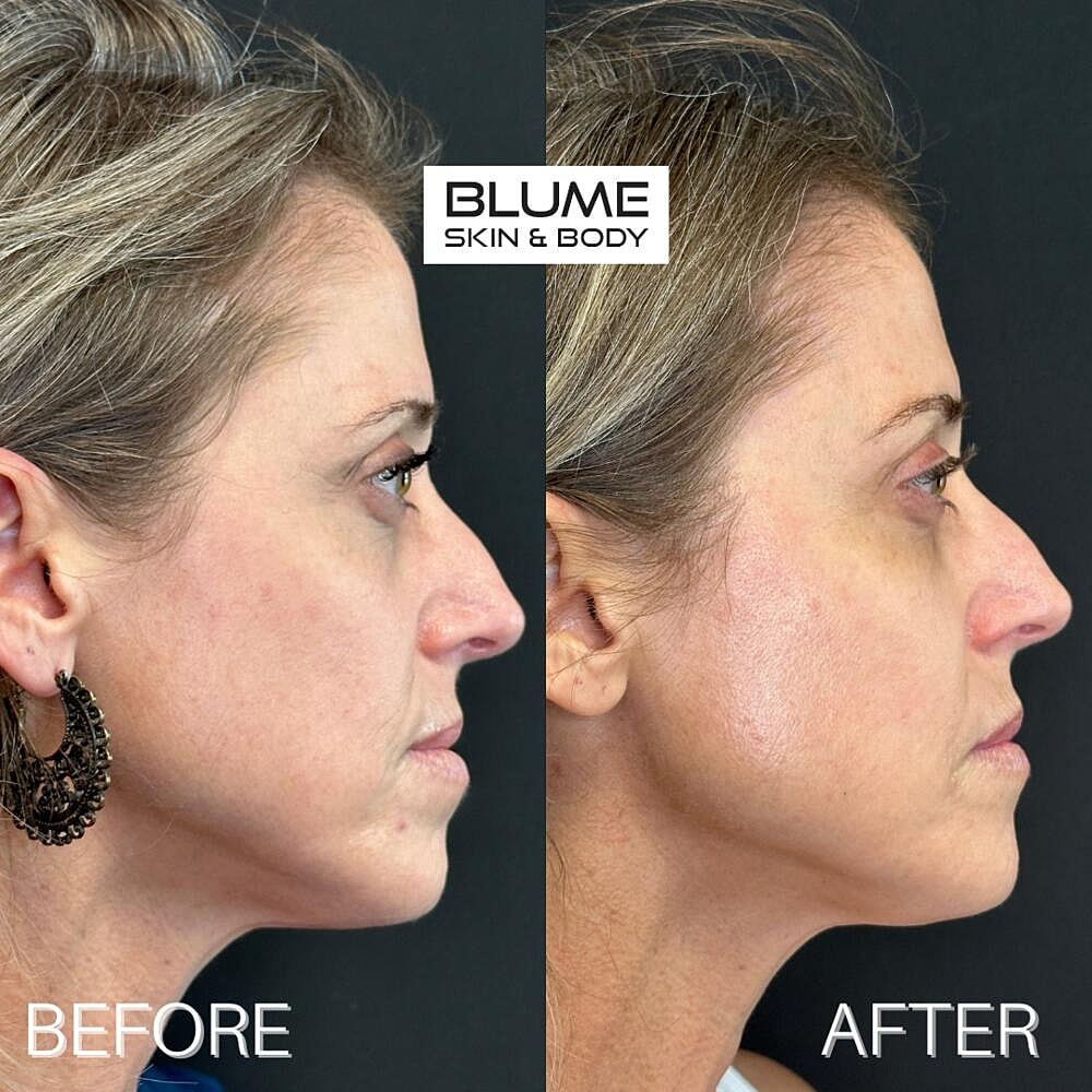 Dermal Fillers Before & After