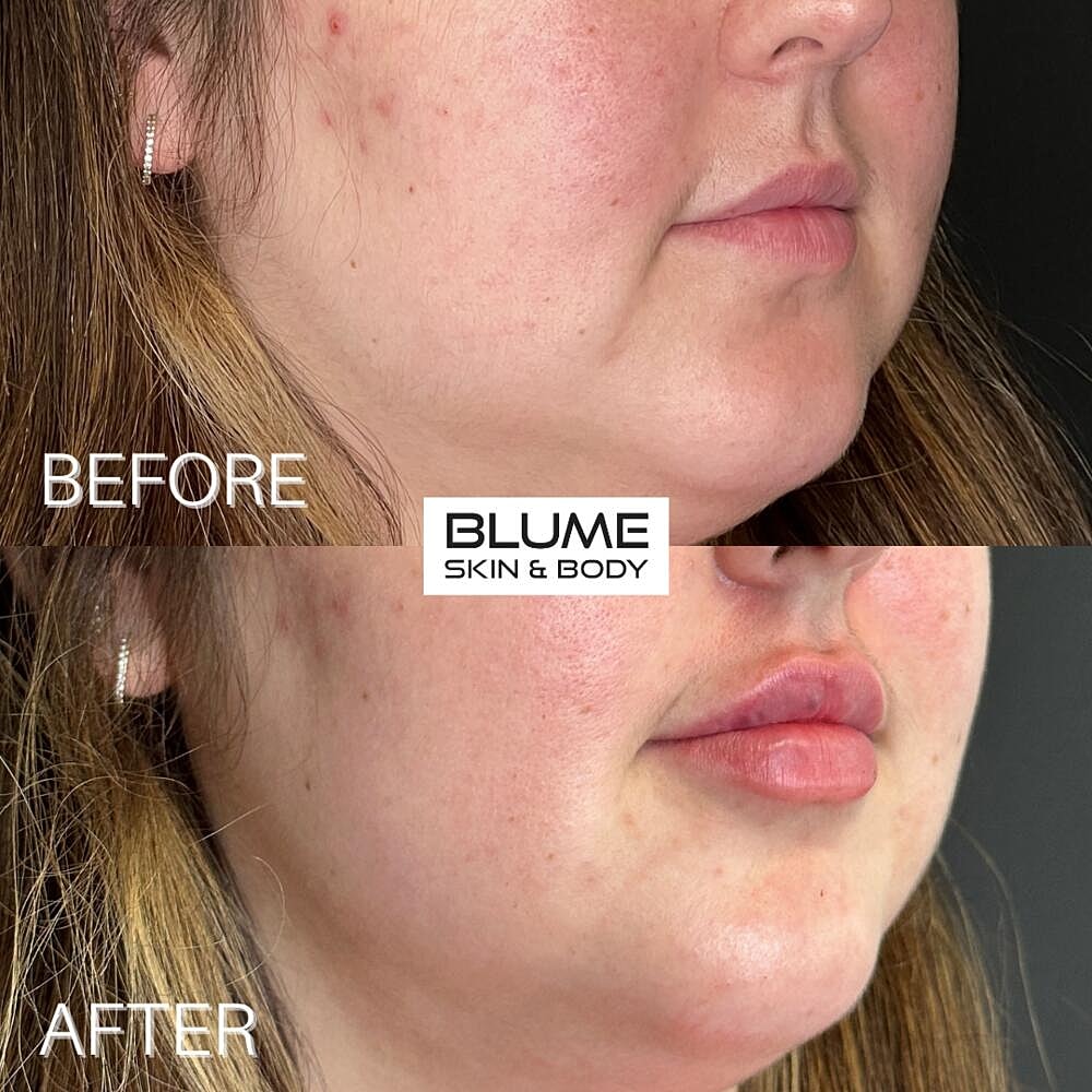 Dermal Fillers Before & After