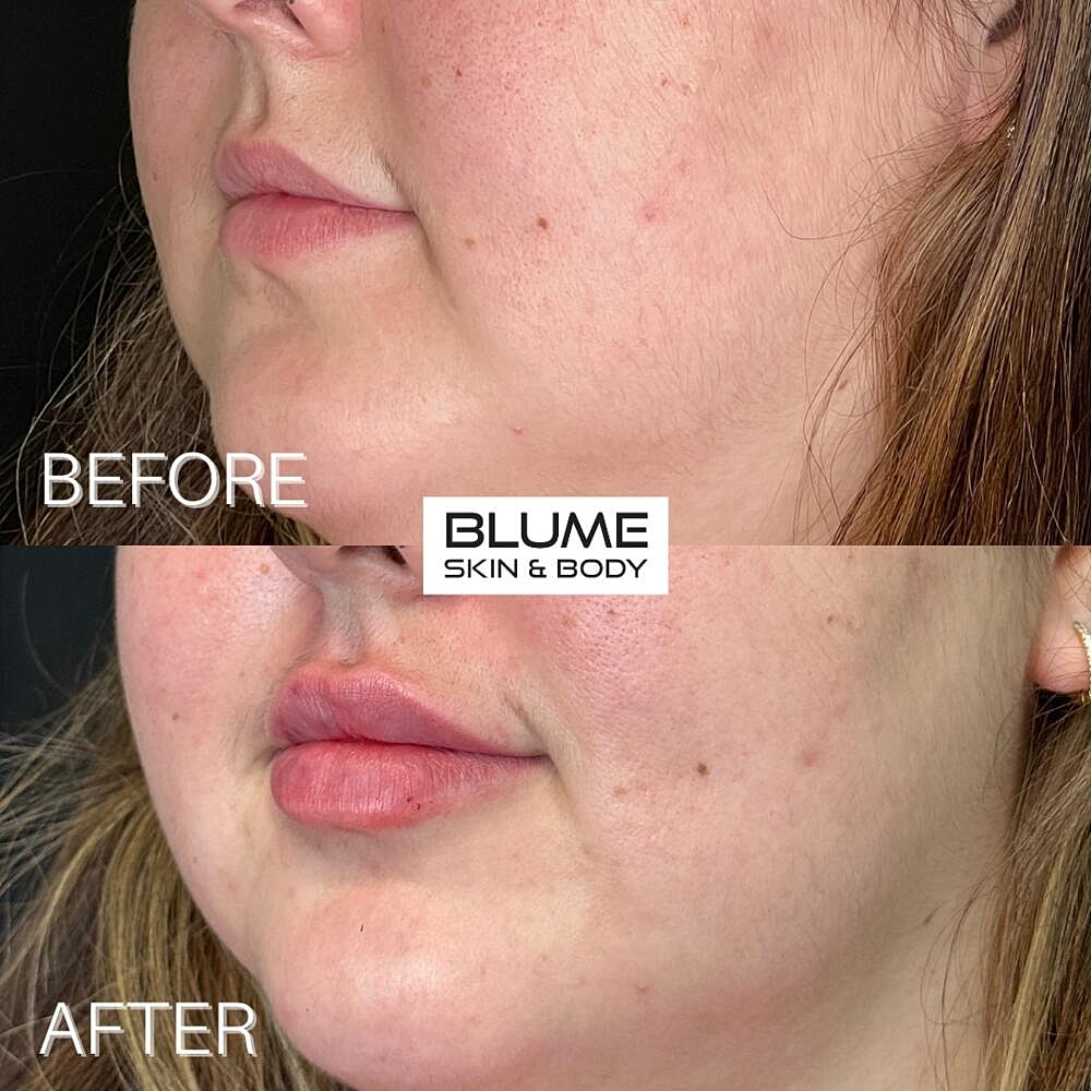 Dermal Fillers Before & After