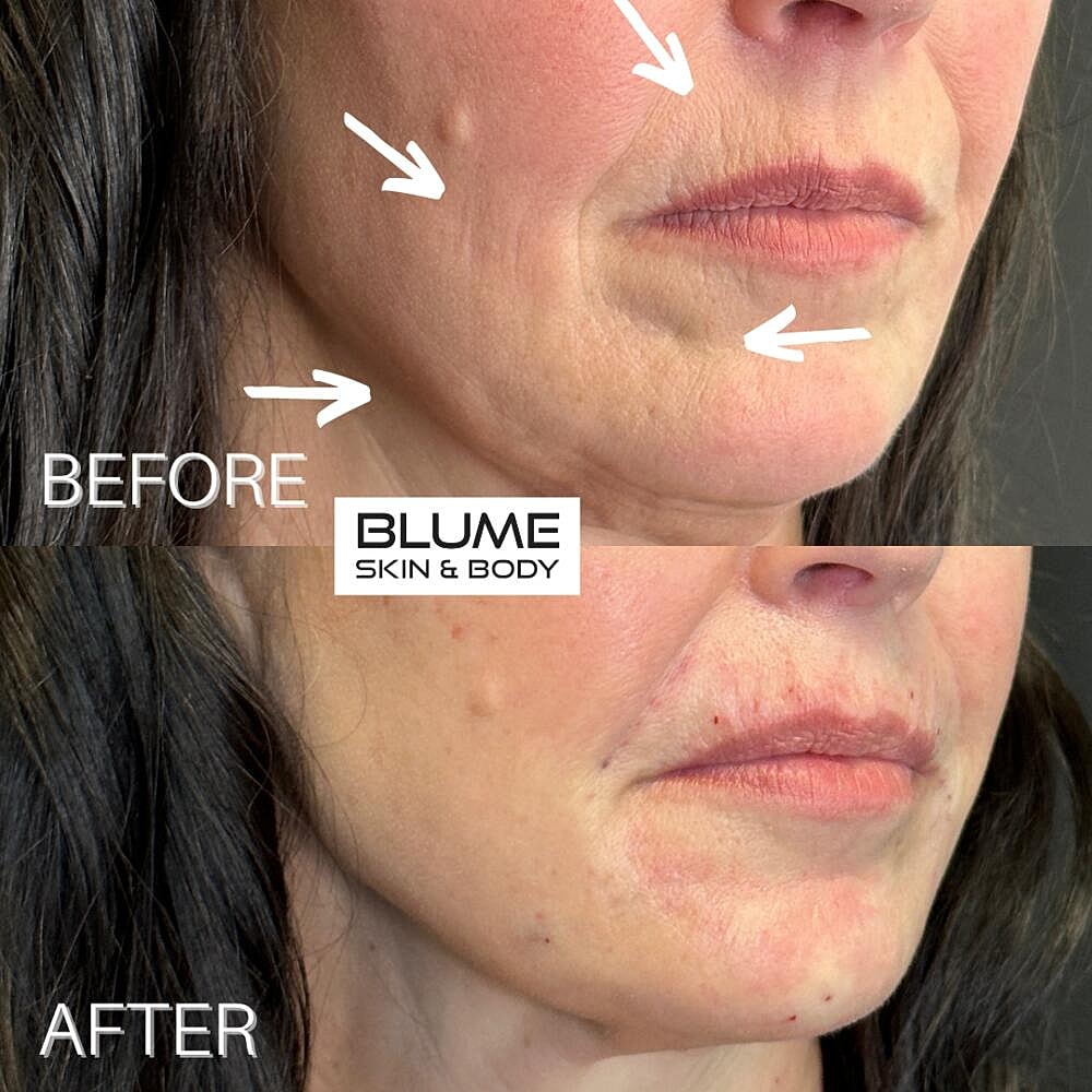 Dermal Fillers Before & After