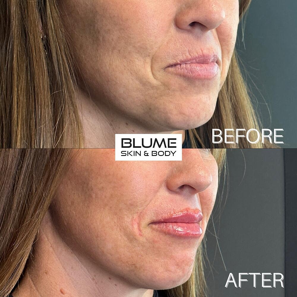 Dermal Fillers Before & After