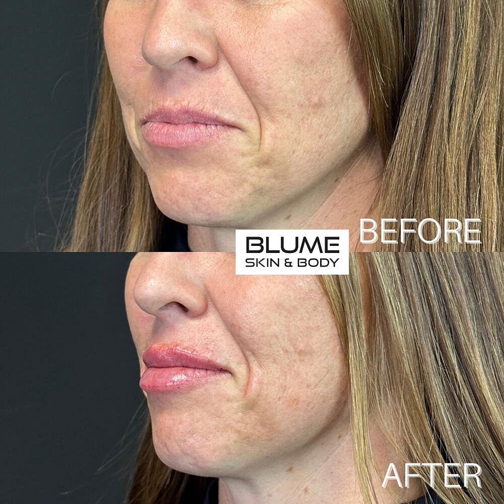 Dermal Fillers Before & After