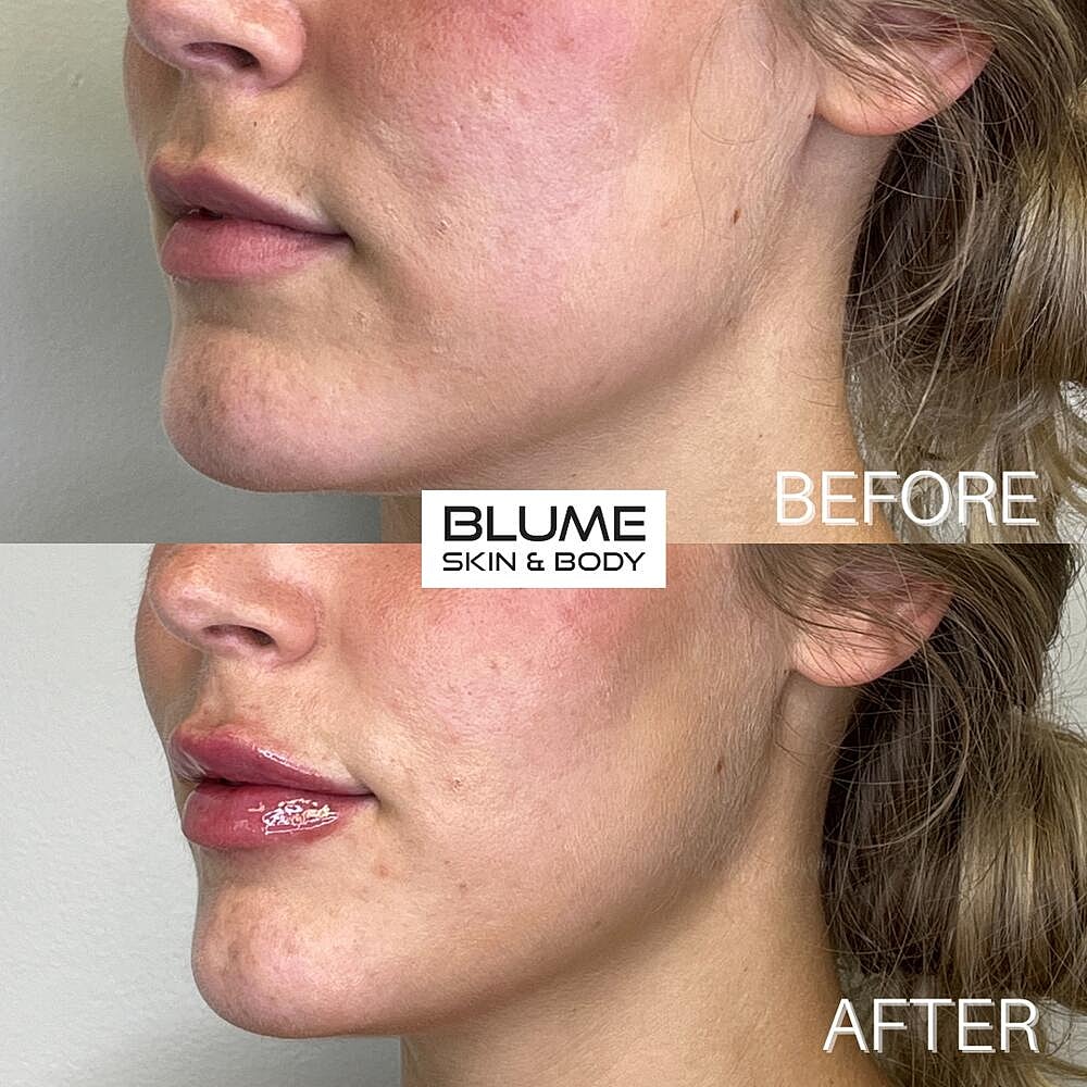 Dermal Fillers Before & After