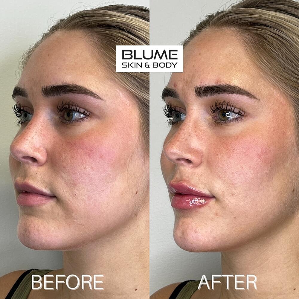Dermal Fillers Before & After