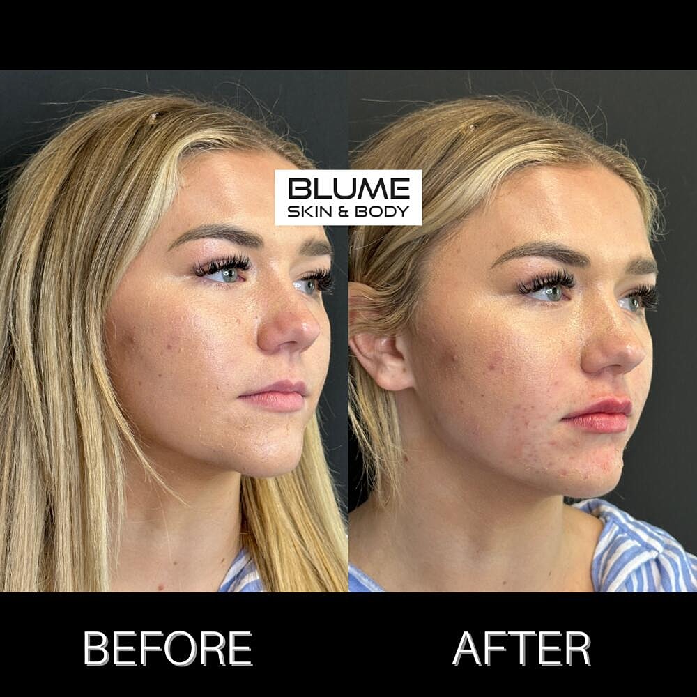 Dermal Fillers Before & After