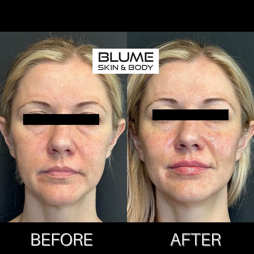 Dermal Fillers Before & After