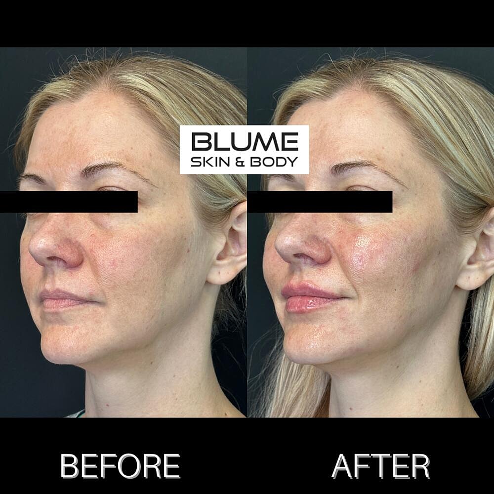 Dermal Fillers Before & After