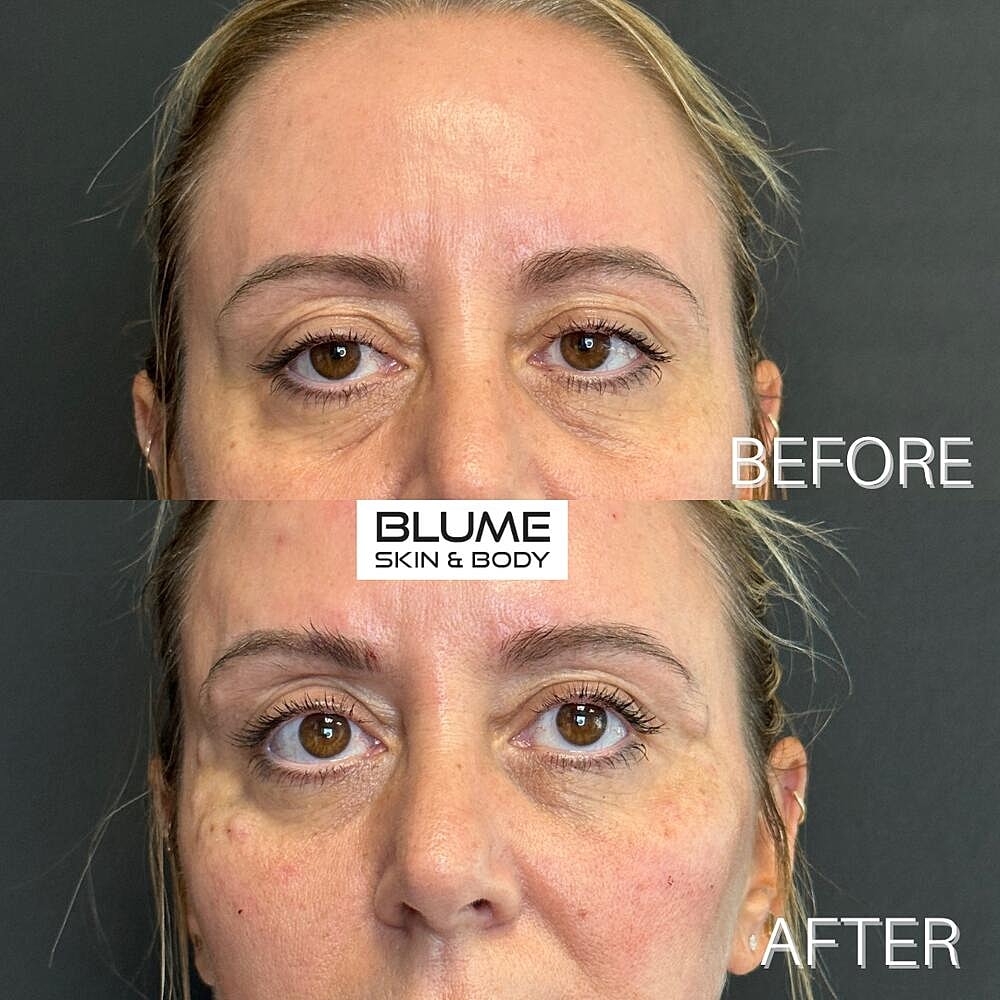 Dermal Fillers Before & After