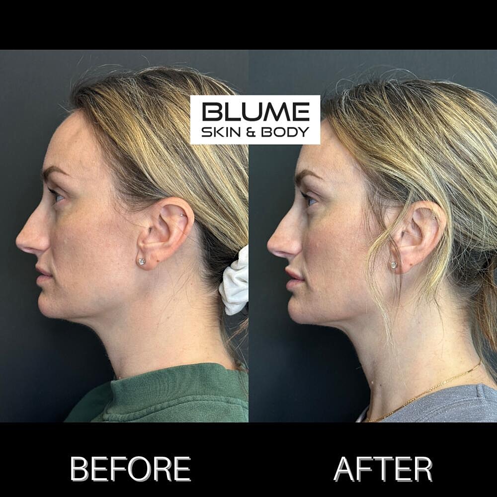 Dermal Fillers Before & After
