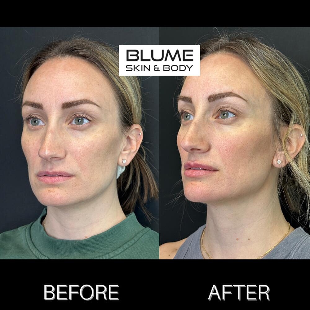 Dermal Fillers Before & After