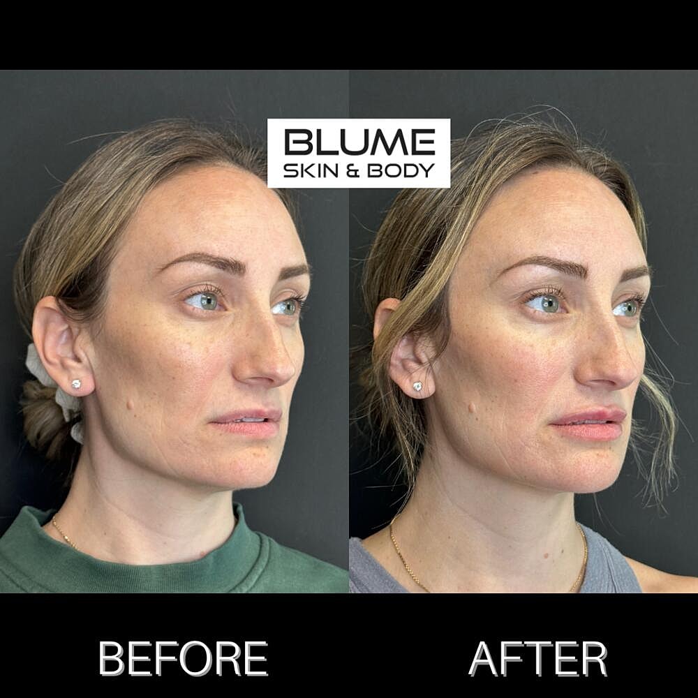 Dermal Fillers Before & After