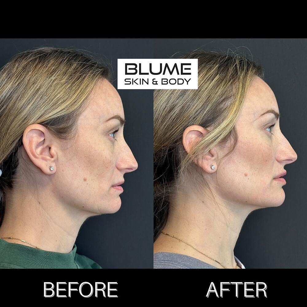Dermal Fillers Before & After