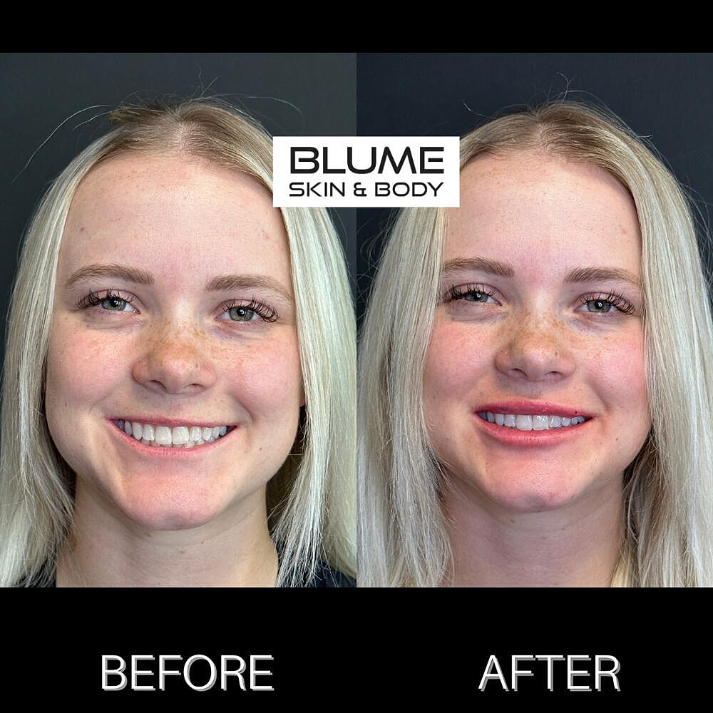 Dermal Fillers Before & After