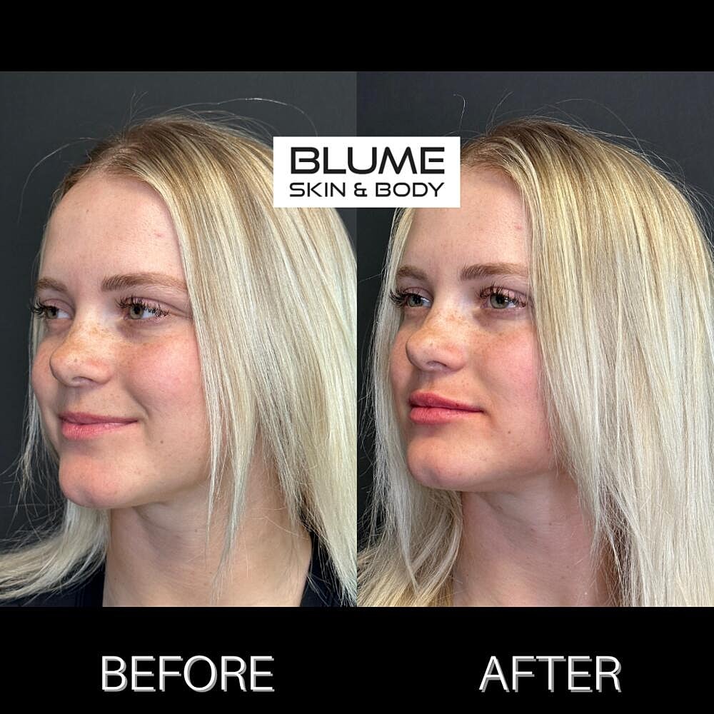 Dermal Fillers Before & After