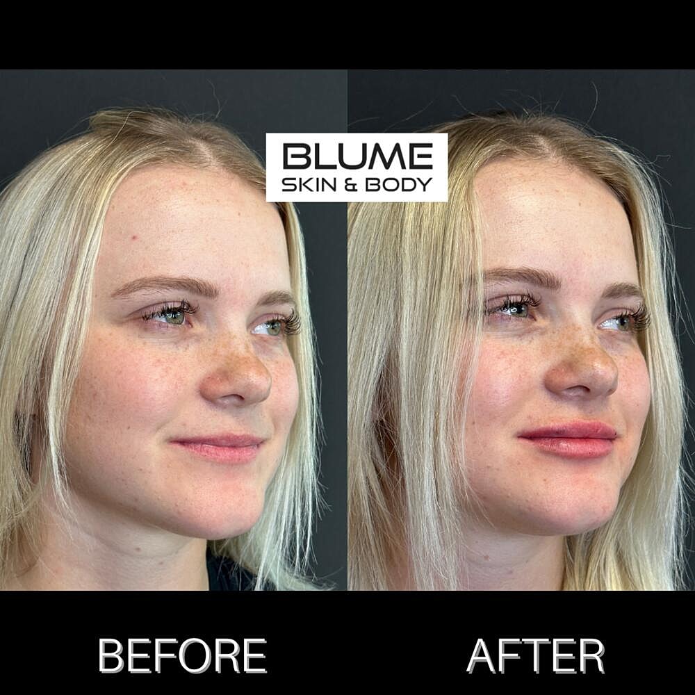 Dermal Fillers Before & After
