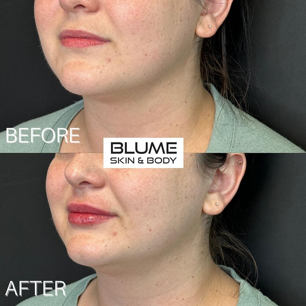 Dermal Fillers Before & After