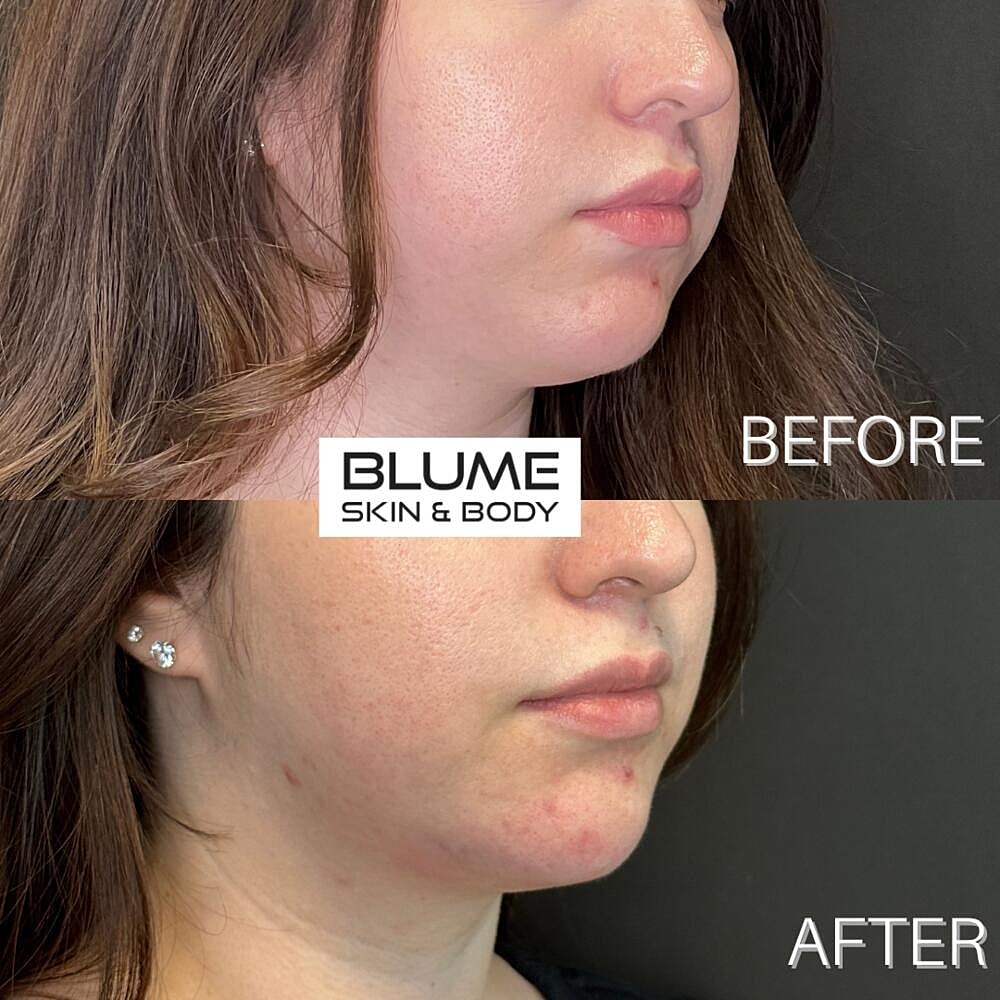 Dermal Fillers Before & After