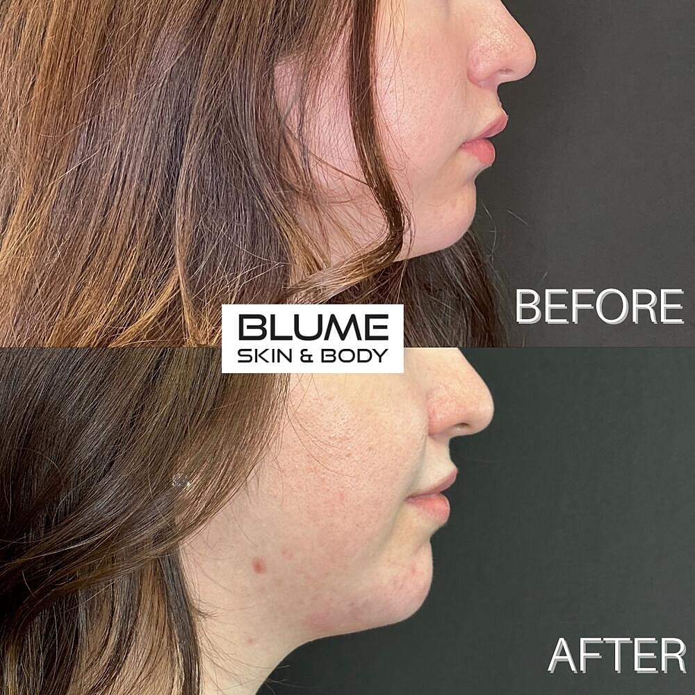 Dermal Fillers Before & After