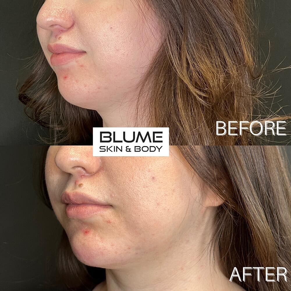 Dermal Fillers Before & After
