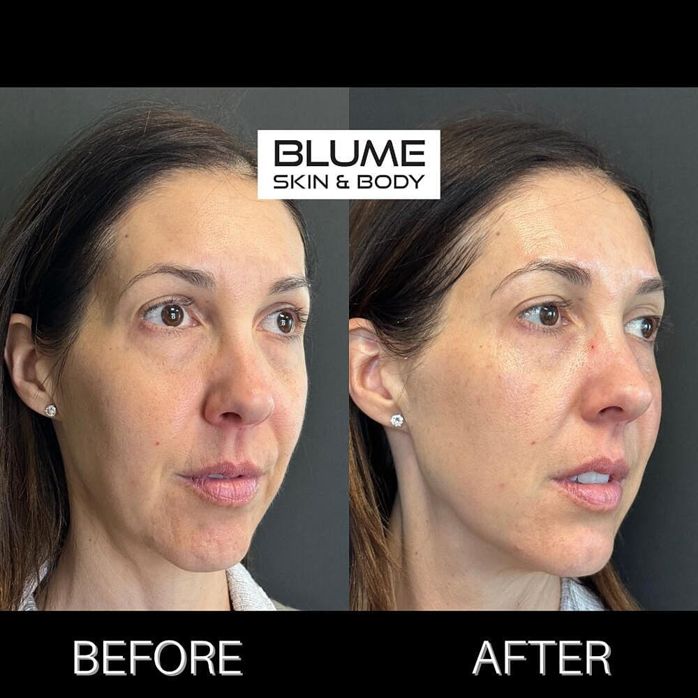 Dermal Fillers Before & After