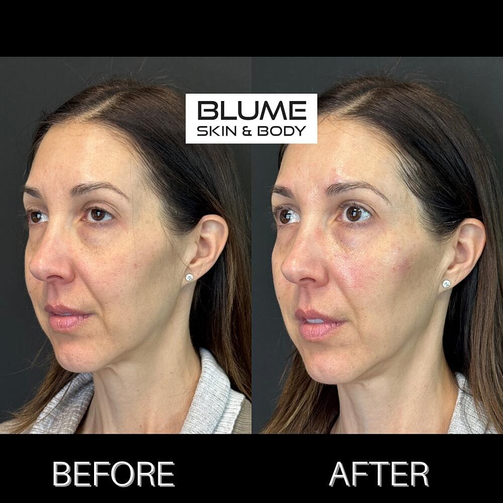 Dermal Fillers Before & After