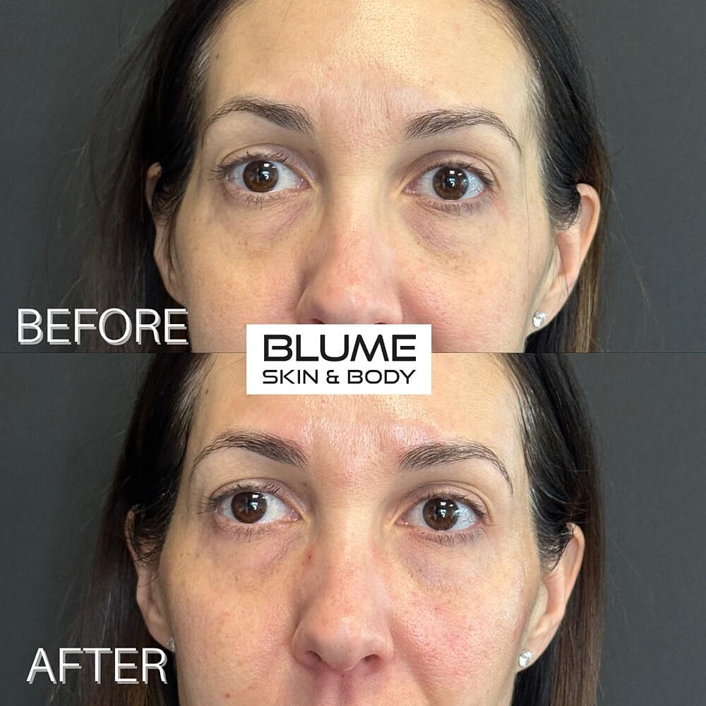 Dermal Fillers Before & After