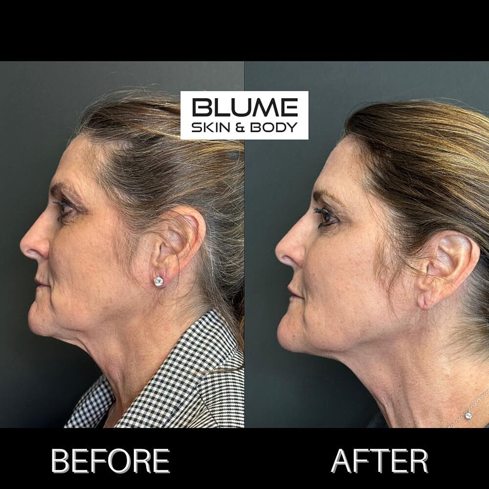 Dermal Fillers Before & After