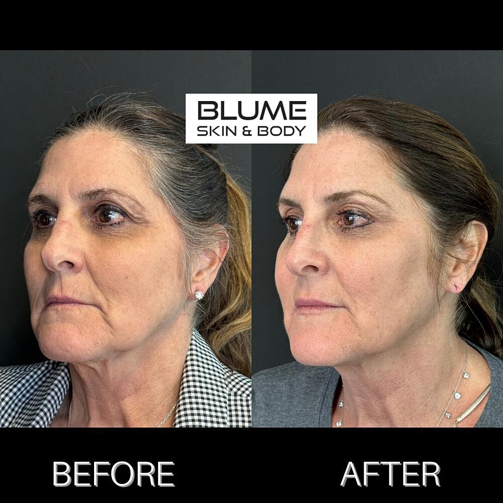 Dermal Fillers Before & After