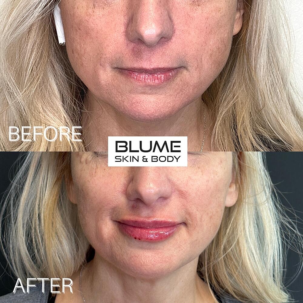 Dermal Fillers Before & After