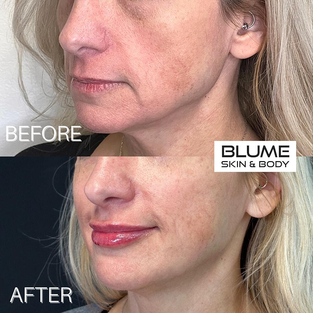 Dermal Fillers Before & After