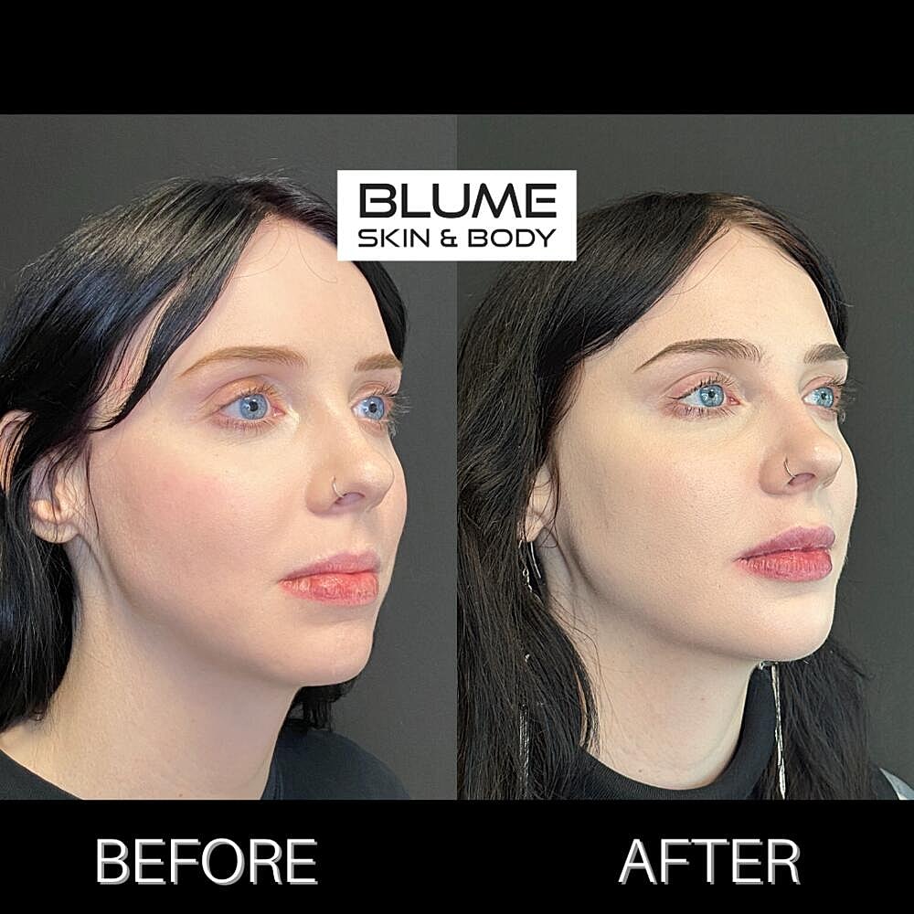 Dermal Fillers Before & After