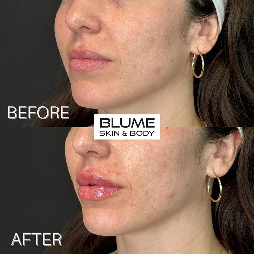 Dermal Fillers Before & After
