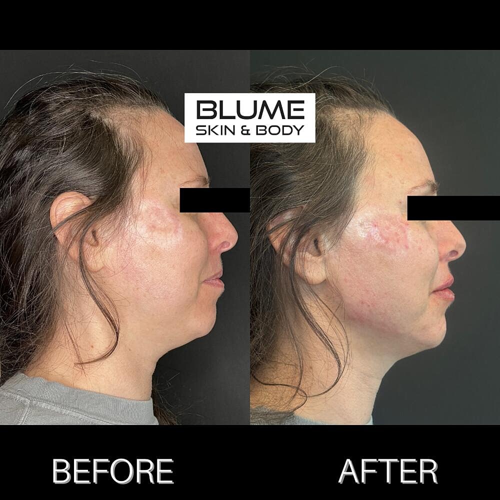 Dermal Fillers Before & After