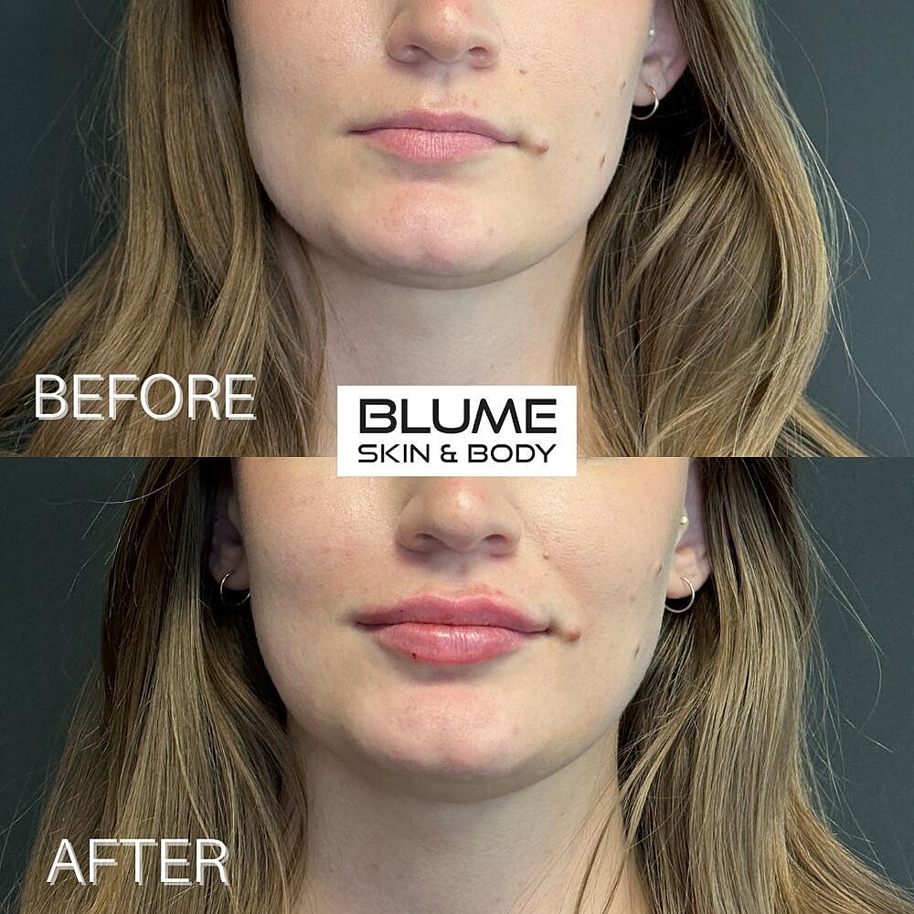 Dermal Fillers Before & After