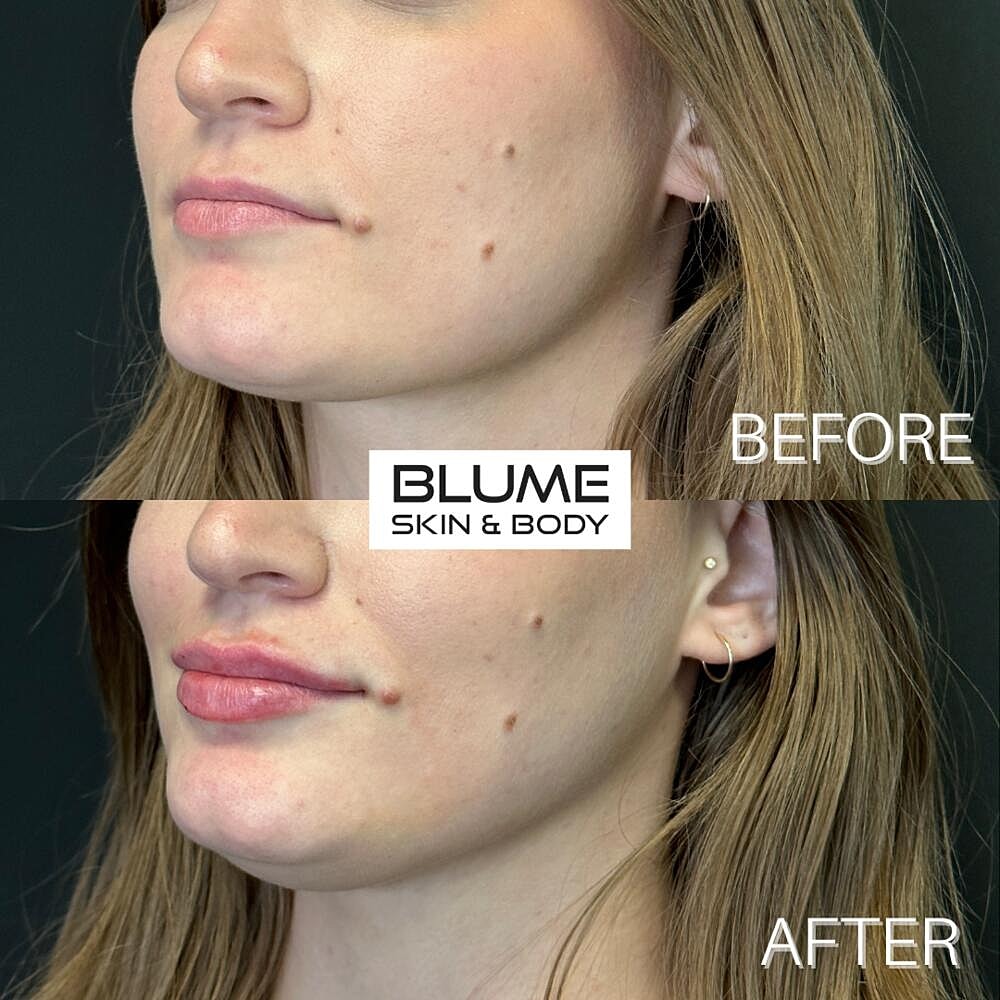 Dermal Fillers Before & After