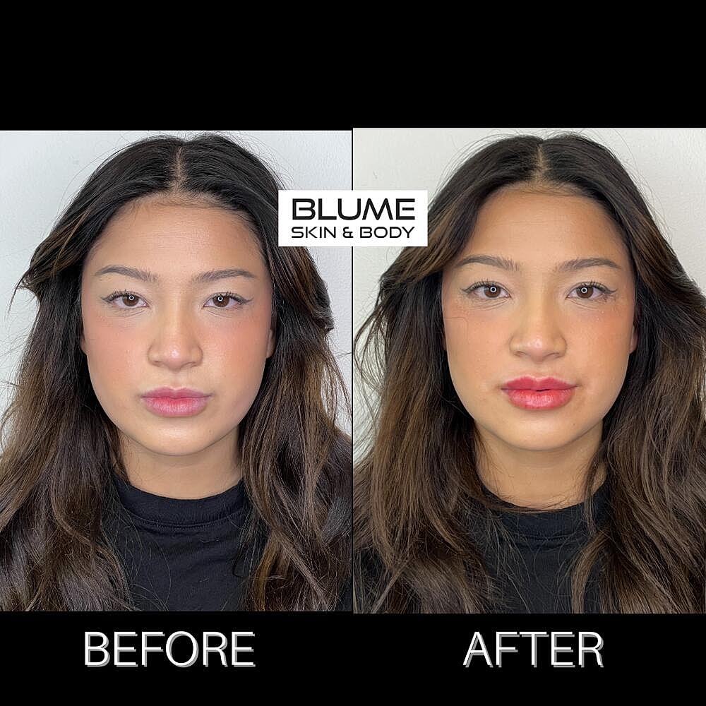 Dermal Fillers Before & After
