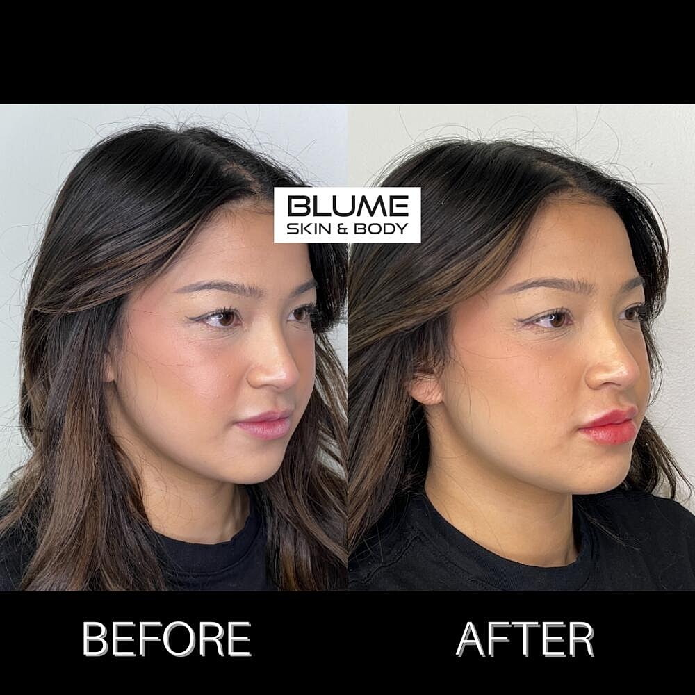 Dermal Fillers Before & After