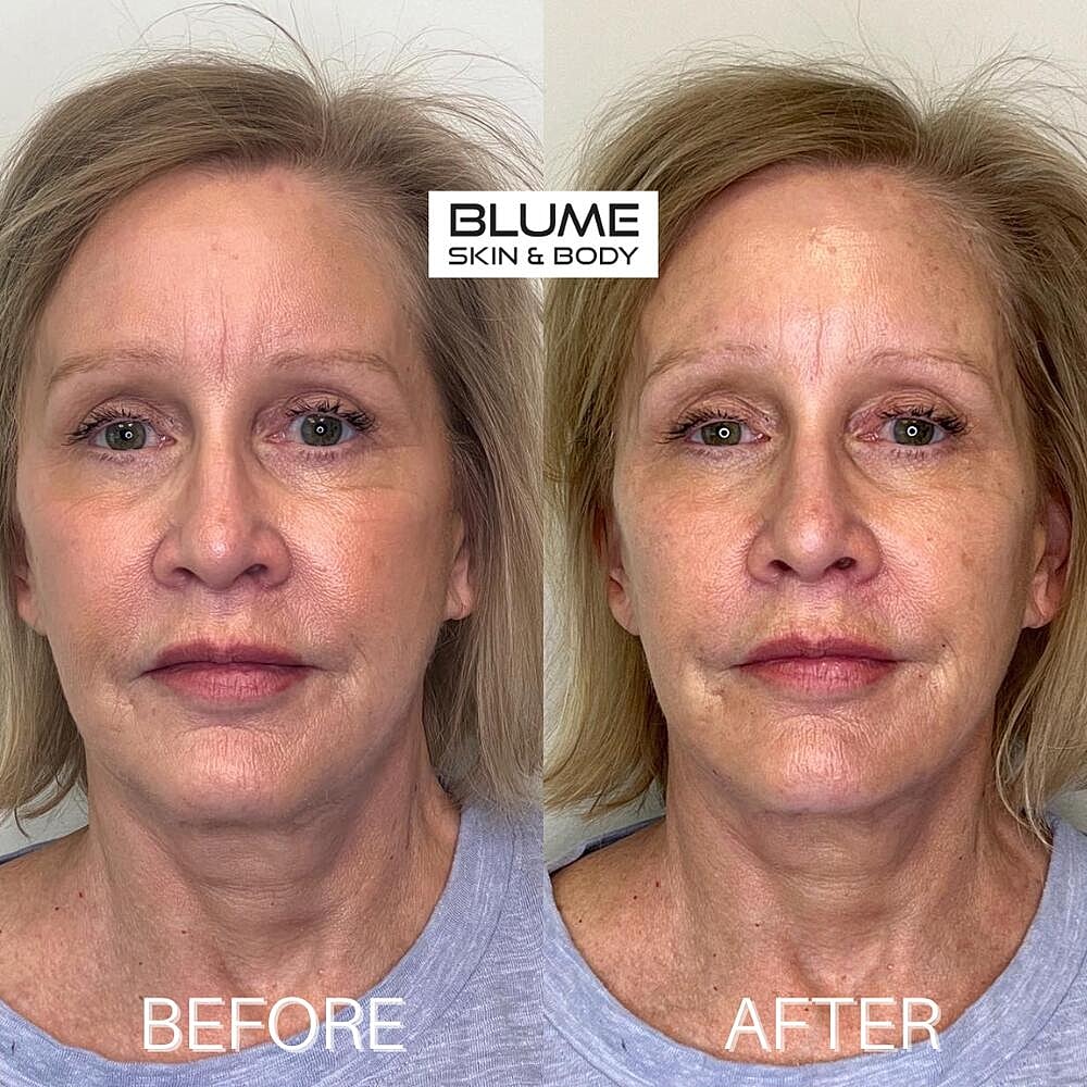 Dermal Fillers Before & After