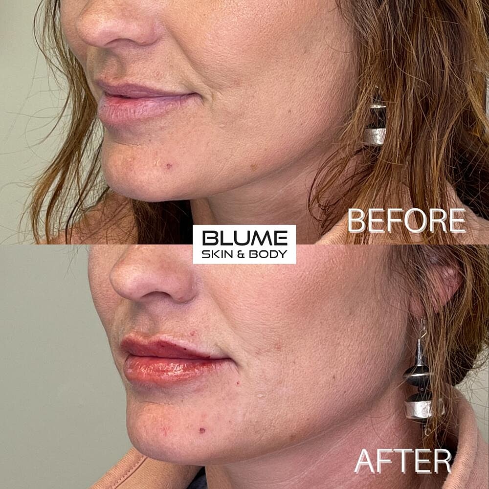Dermal Fillers Before & After
