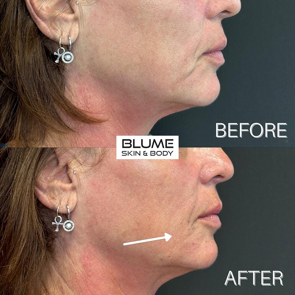 Dermal Fillers Before & After