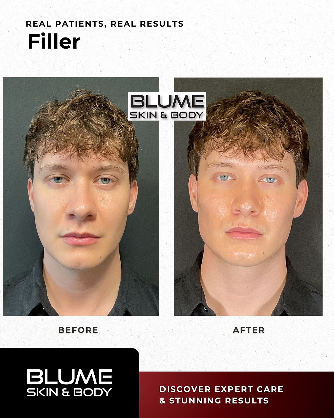 Before and after filler treatment results.