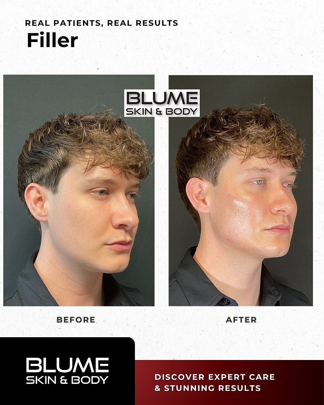 Before and after filler treatment results.