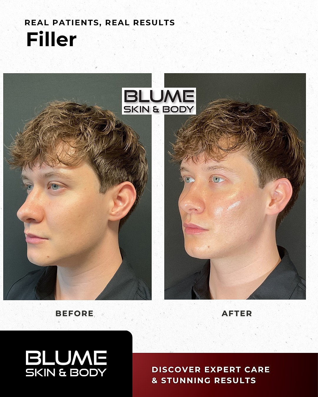 Before and after filler treatment results.