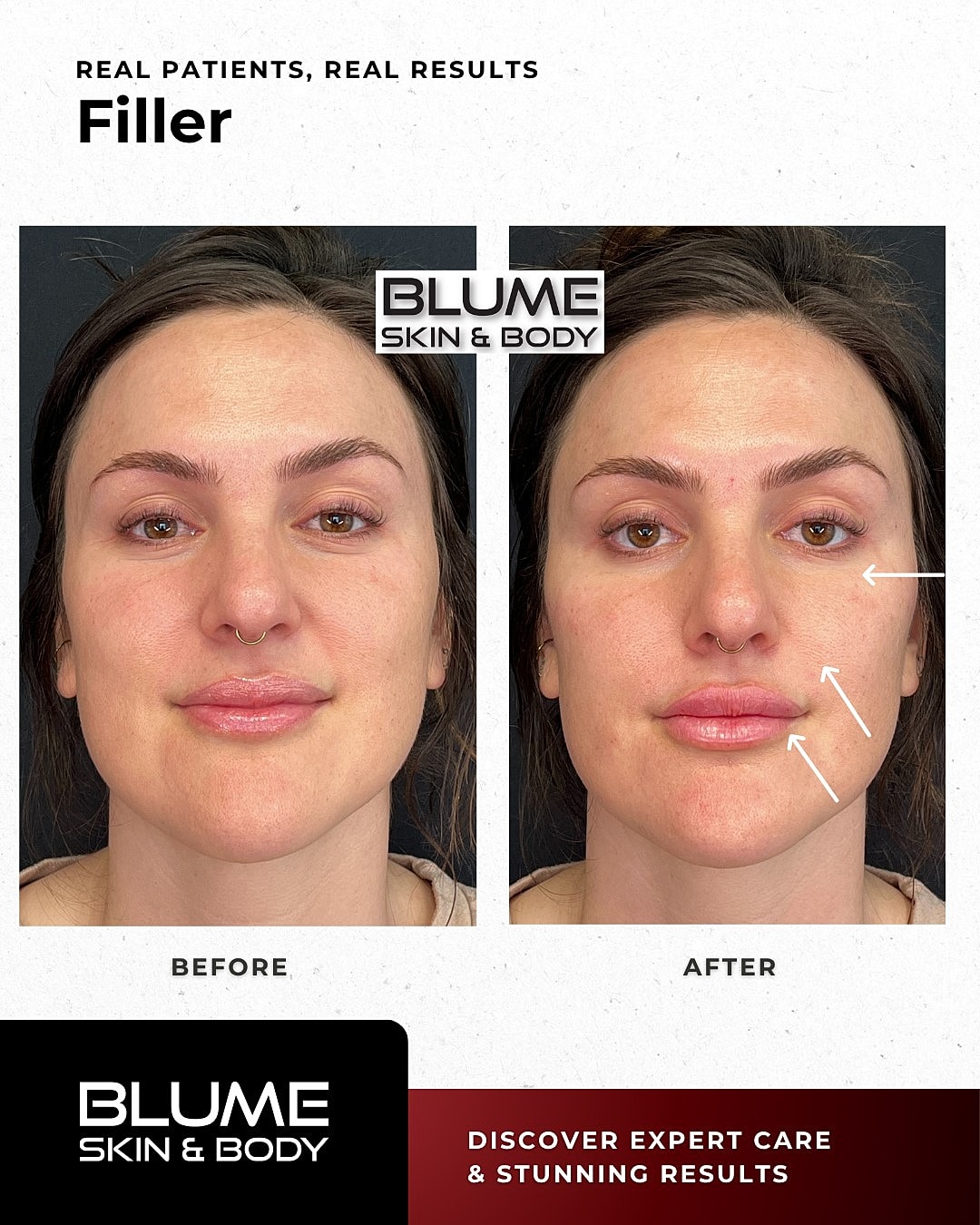 Dermal Fillers Before & After