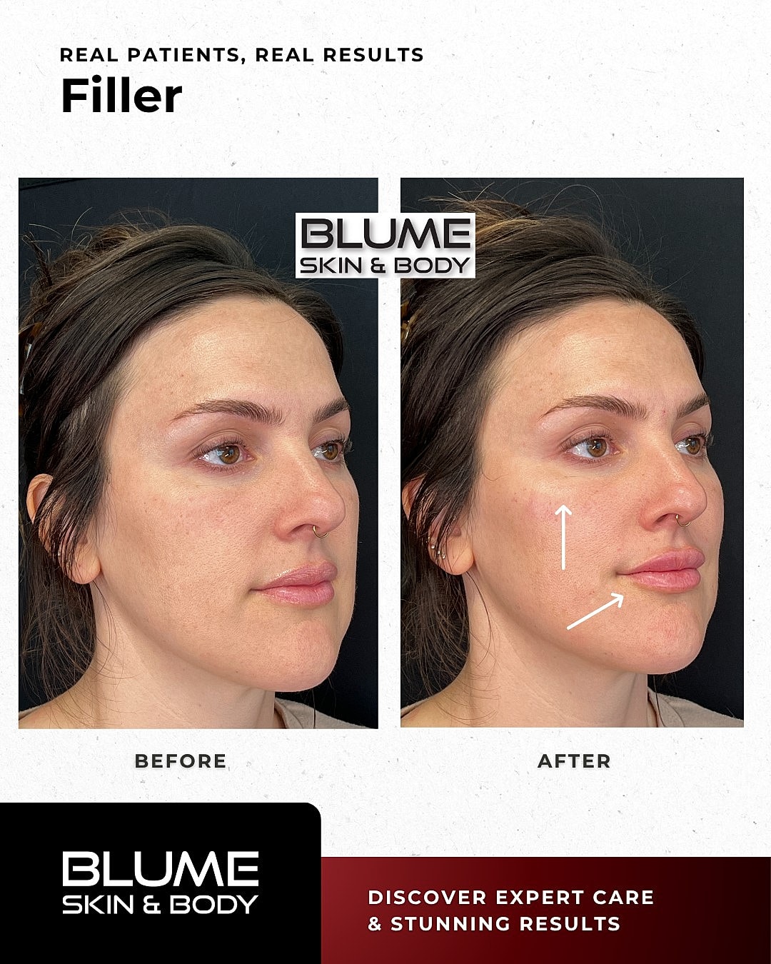Dermal Fillers Before & After