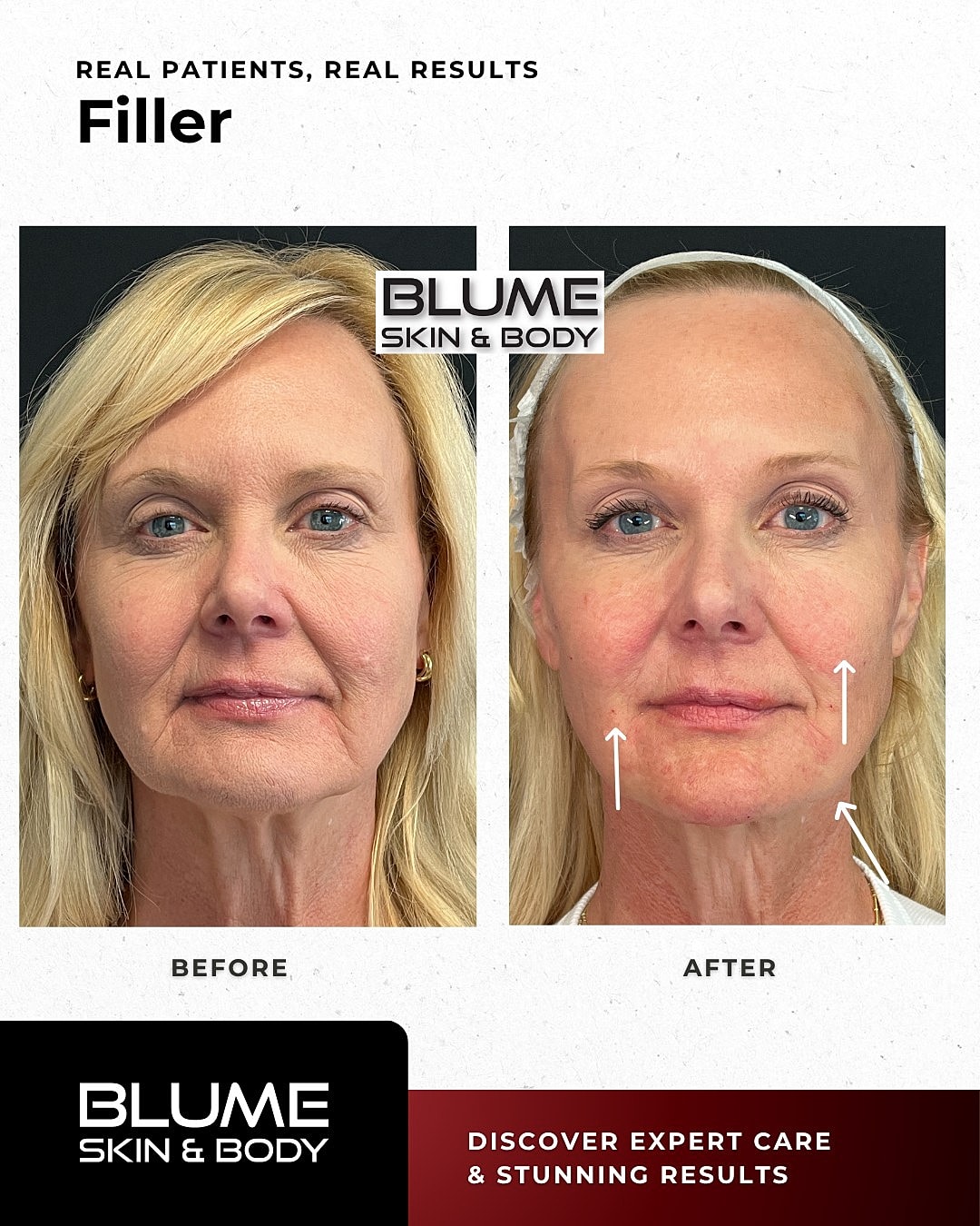 Dermal Fillers Before & After