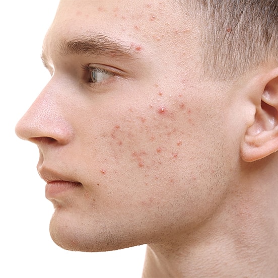 Side profile of young man with acne.